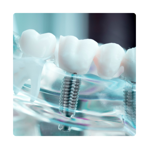 ایمپلنت دندان نازی آباد