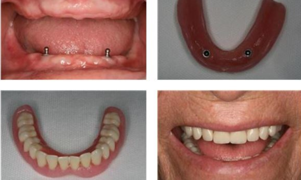 چالش اتصال دندان طبیعی به ایمپلنت در دندانپزشکی نازی آباد