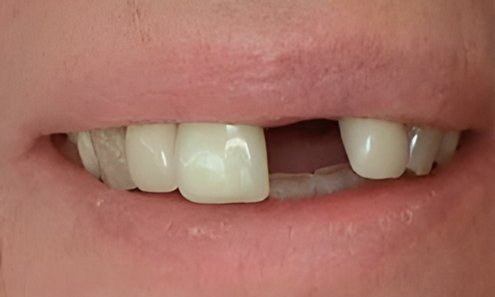 قبل از ایمپلنت