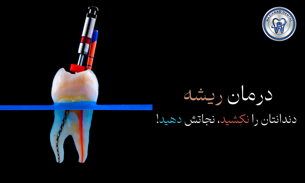 عصب کشی دندان با دستگاه روتاری در نازی آباد