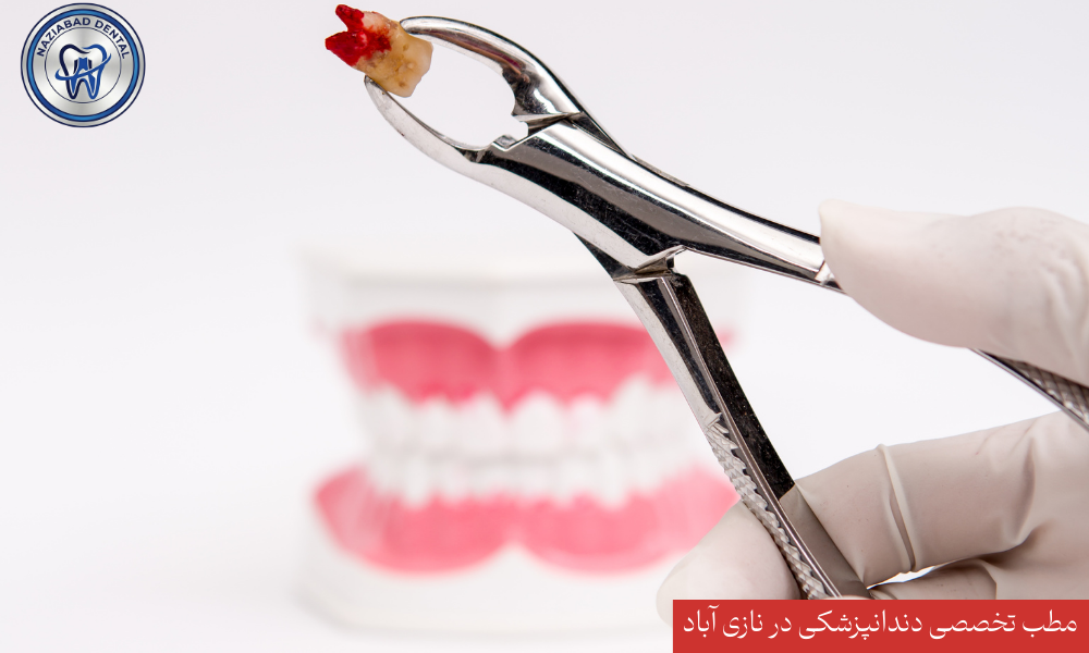 جراحی دندان عقل نهفته در نازی آباد