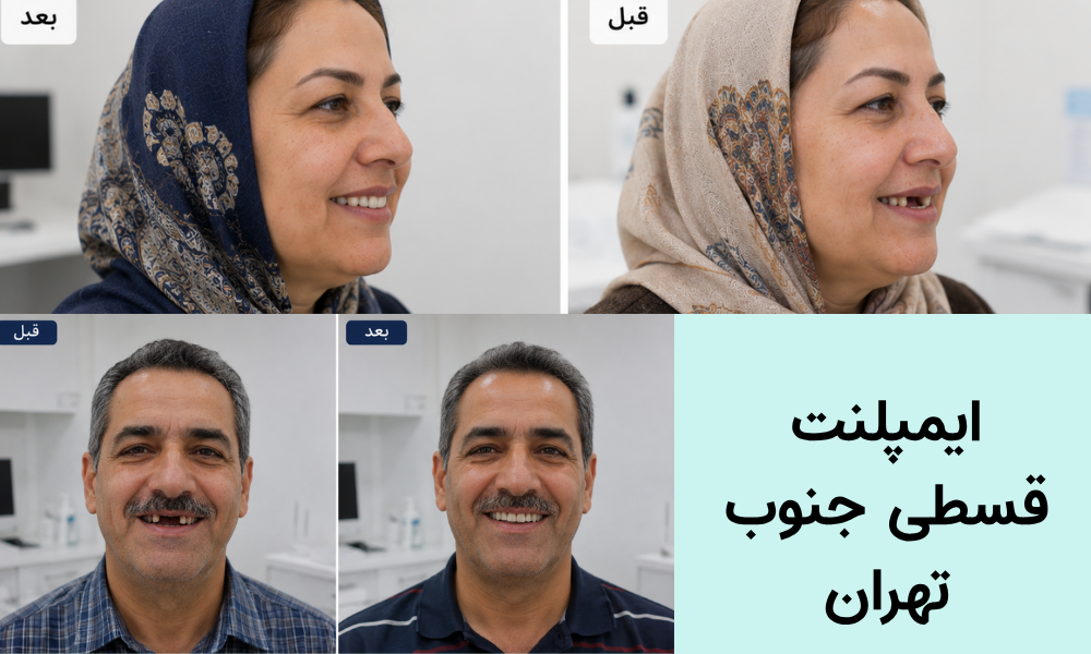 ایمپلنت قسطی در نازی آباد و جنوب تهران
