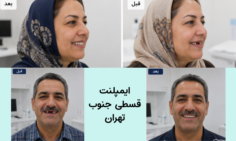 ایمپلنت قسطی جنوب تهران نازی اباد