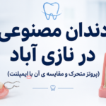 دندان مصنوعی در نازی آباد(پروتز متحرک و مقایسه ی آن با ایمپلنت)