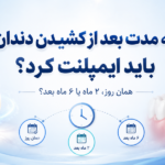 چه مدت بعد از کشیدن دندان باید ایمپلنت کرد؟