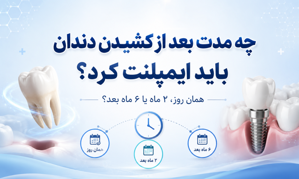 ایمپلنت همان روز بعد از کشیدن دندان