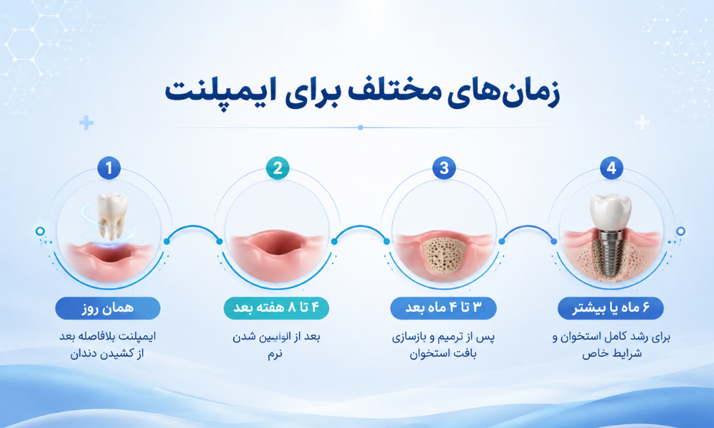 چه مدت بعد از کشیدن دندان باید ایمپلنت کرد