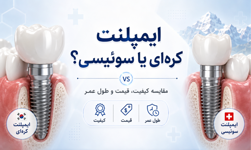 مقایسه ایمپلنت کره ای و سوئیسی از نظر کیفیت قیمت و طول عمر
