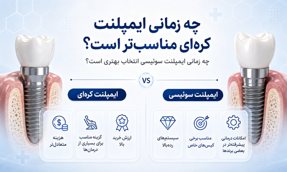 عوامل مهم موفقیت ایمپلنت علاوه بر کشور سازنده