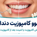 ریموو کامپوزیت دندان