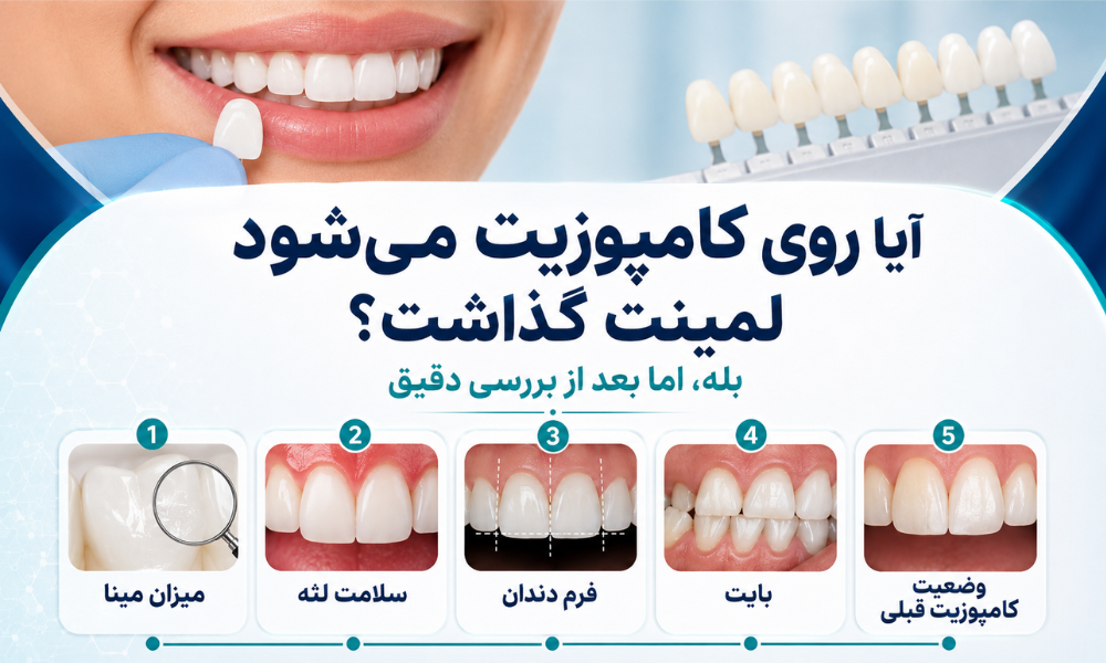آیا روی کامپوزیت می شود لمینت گذاشت و چه مواردی باید قبل از آن بررسی شود