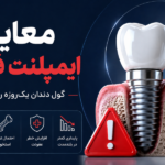 معایب ایمپلنت فوری