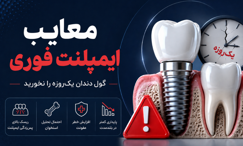 معایب ایمپلنت فوری